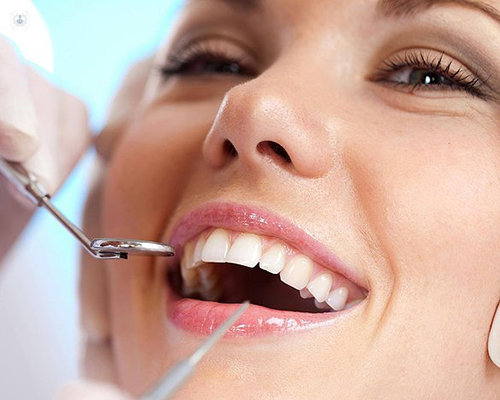 Dental Implants in Tampa: A Comprehensive Guide to Restoring Your Smile