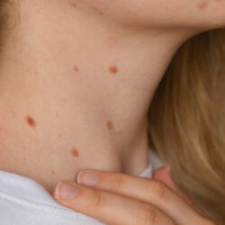 Are Skin Tags Contagious