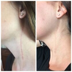 Laser Scar Removal in Riyadh